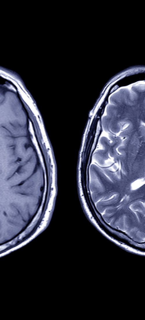 Comparison MRI brain Axial T1 and T2  for detect a variety of conditions of the brain such as cysts, tumors, bleeding, swelling, developmental and structural abnormalities, infections.